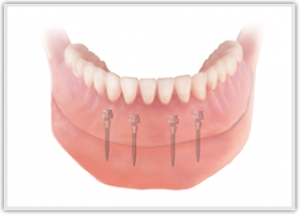 Keyhole Dental Implants Moorabbin
