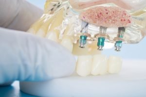 Dental Implants In Cheltenham The Benefits And Advantages