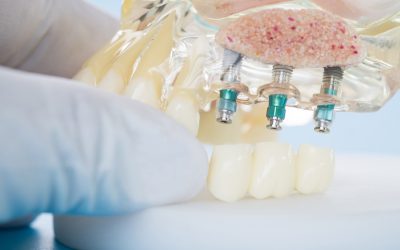 Dental Implants In Moorabbin: The Benefits And Advantages