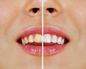 Your Ultimate Guide to Teeth Whitening in Cheltenham