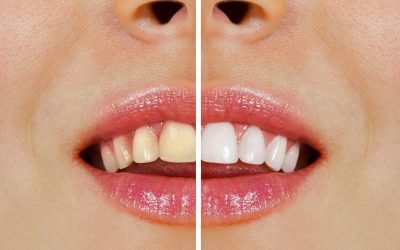 Your Ultimate Guide to Teeth Whitening in Moorabbin