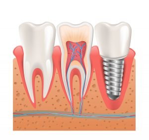 Dental Implants Should You Shop Around Cheltenham