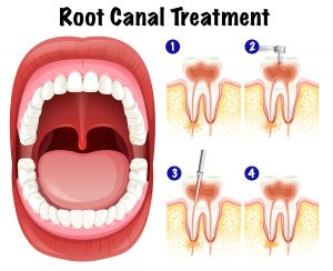 signs that you need root canal treatment cheltenham