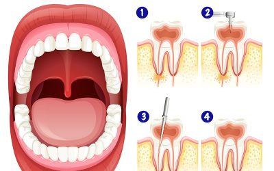 Dental Tips: Signs That You Need Root Canal Treatment