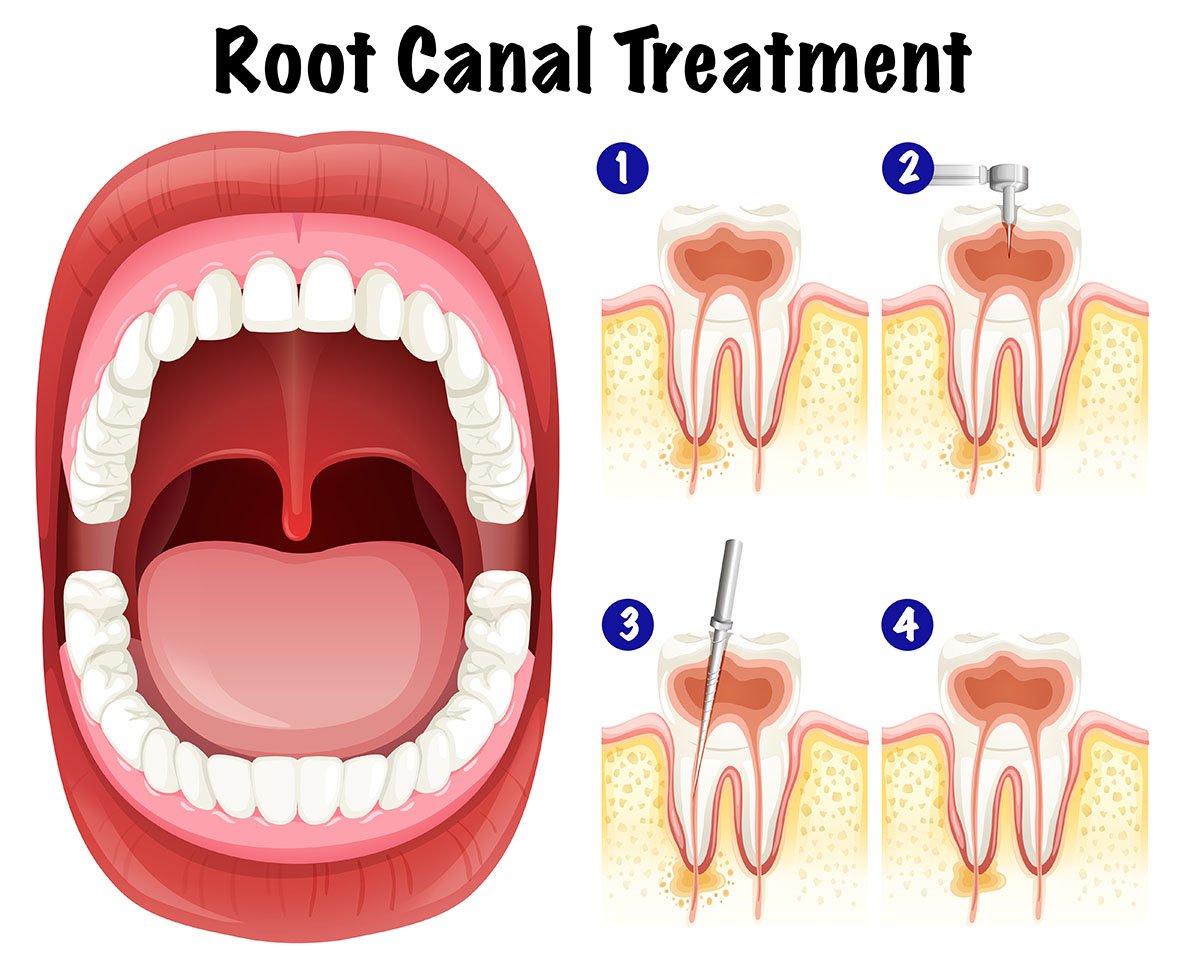 Dental Tips Signs That You Need Root Canal Treatment 