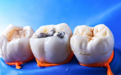 How to Pick the Right Dental Fillings in Moorabbin