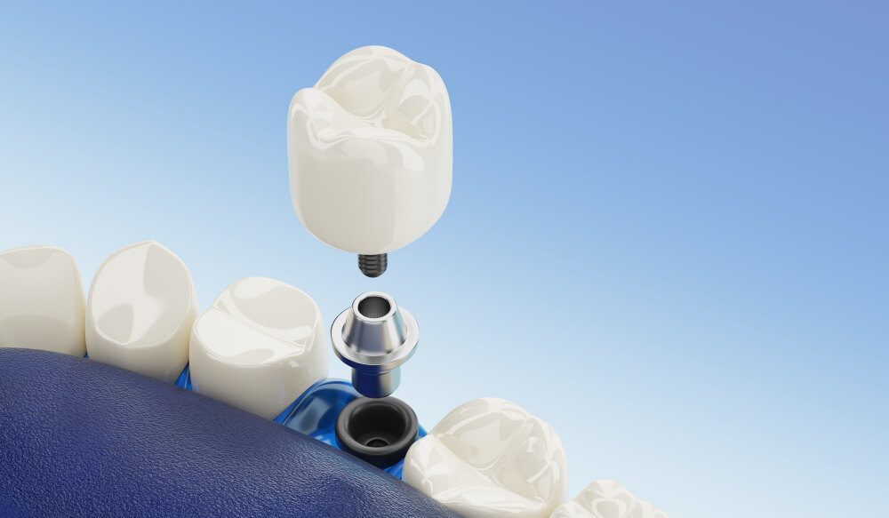Dental Implants in Cheltenham!