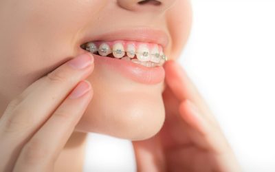 Overbite Correction Treatment – How to Fix an Overbite for Better Oral Health