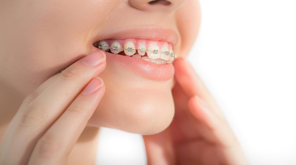 Overbite Correction Treatment – How to Fix an Overbite for Better Oral Health