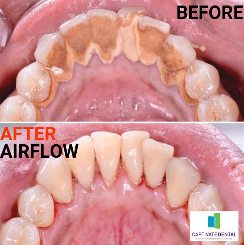 airflow dental spa before and after moorabbin