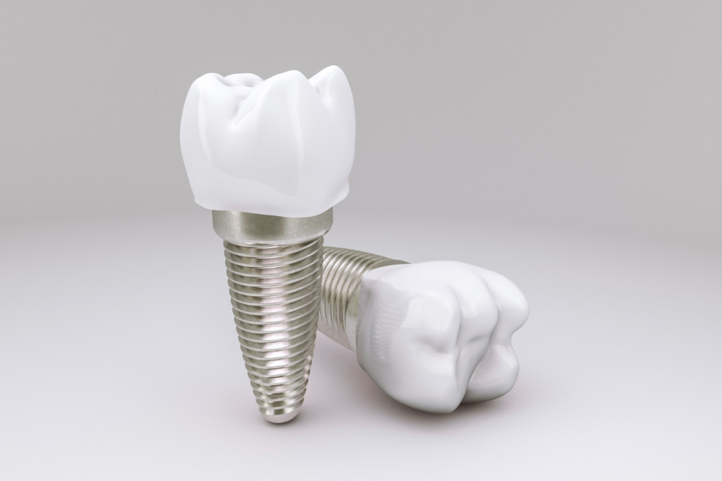 all you need to know about dental implants captivate dental