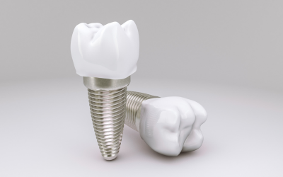 All You Need to Know About Dental Implants: A Comprehensive Guide from Captivate Dental