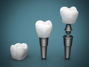 Dental-Implants-Cheltenham
