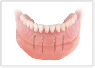 Keyhole-Dental-Implants-cheltenham