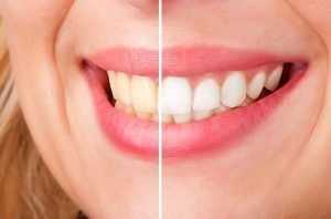 Teeth-Whitening-cheltenham