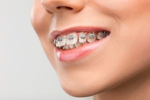 orthodontics-cheltenham
