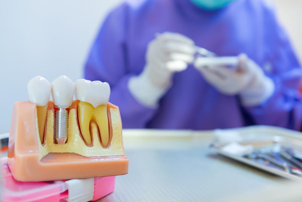 all you need to know about dental implants