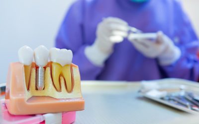 All You Need to Know About Dental Implants: A Comprehensive Guide from Captivate Dental