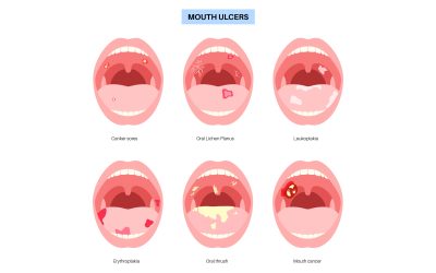 Mouth Ulcers: Causes, Treatment and When to See Your Dentist