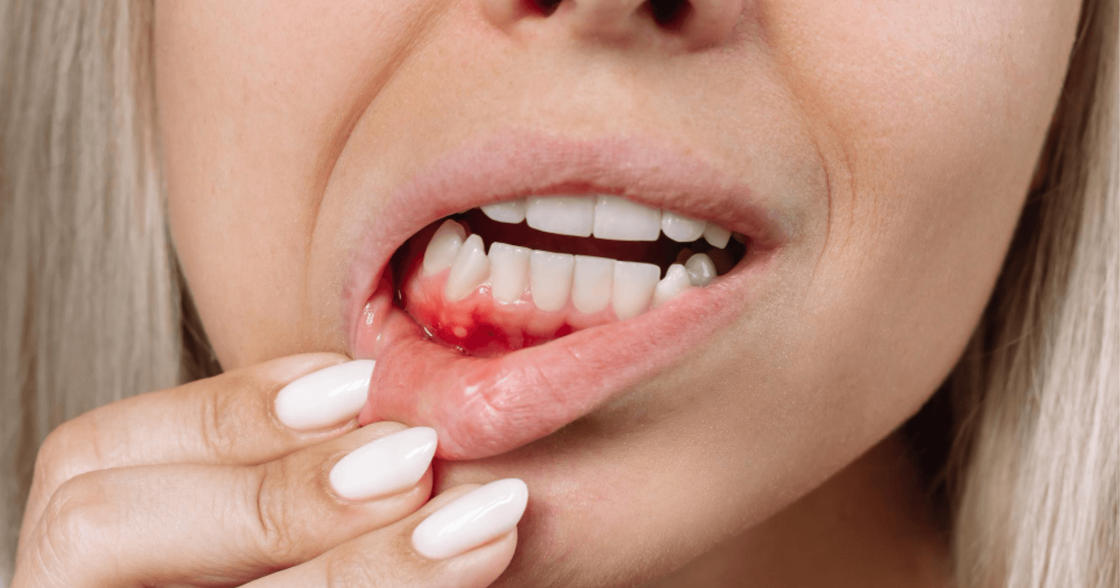 Red swollen gums and recession — early signs of gum disease in Cheltenham