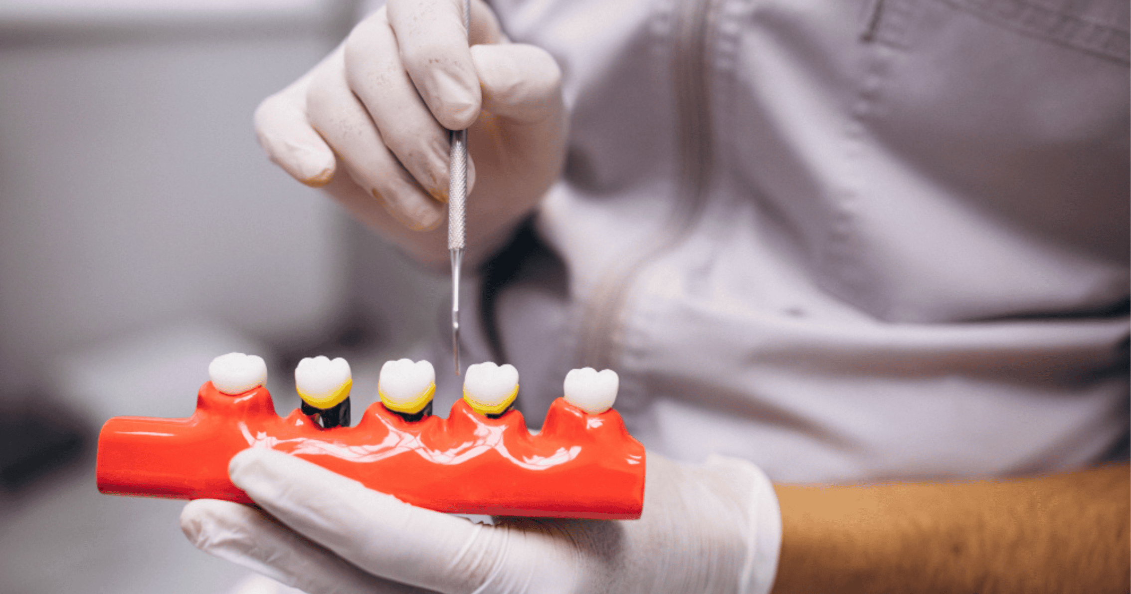 Dental Crown Cost What Affects the Price and What to Expect