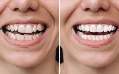 Do I Need Orthodontic Treatment? Signs, Options, and What to Expect