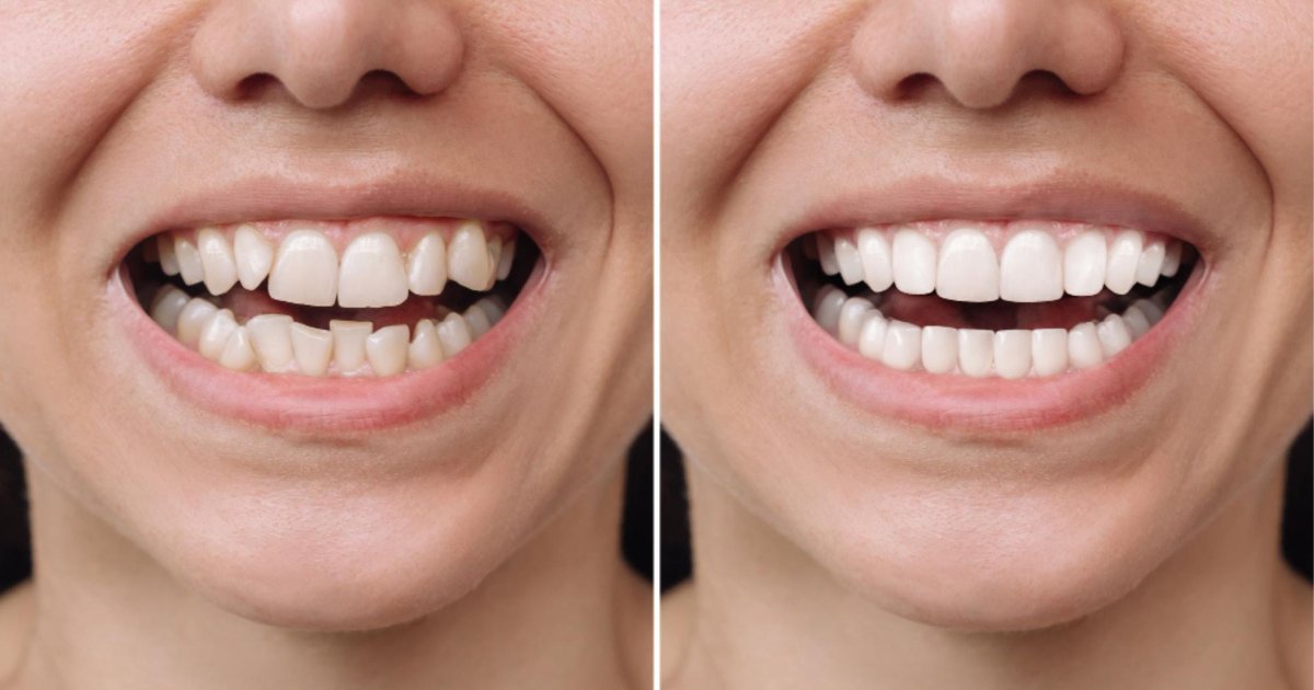 Before and after comparison of teeth alignment following orthodontic treatment in Cheltenham