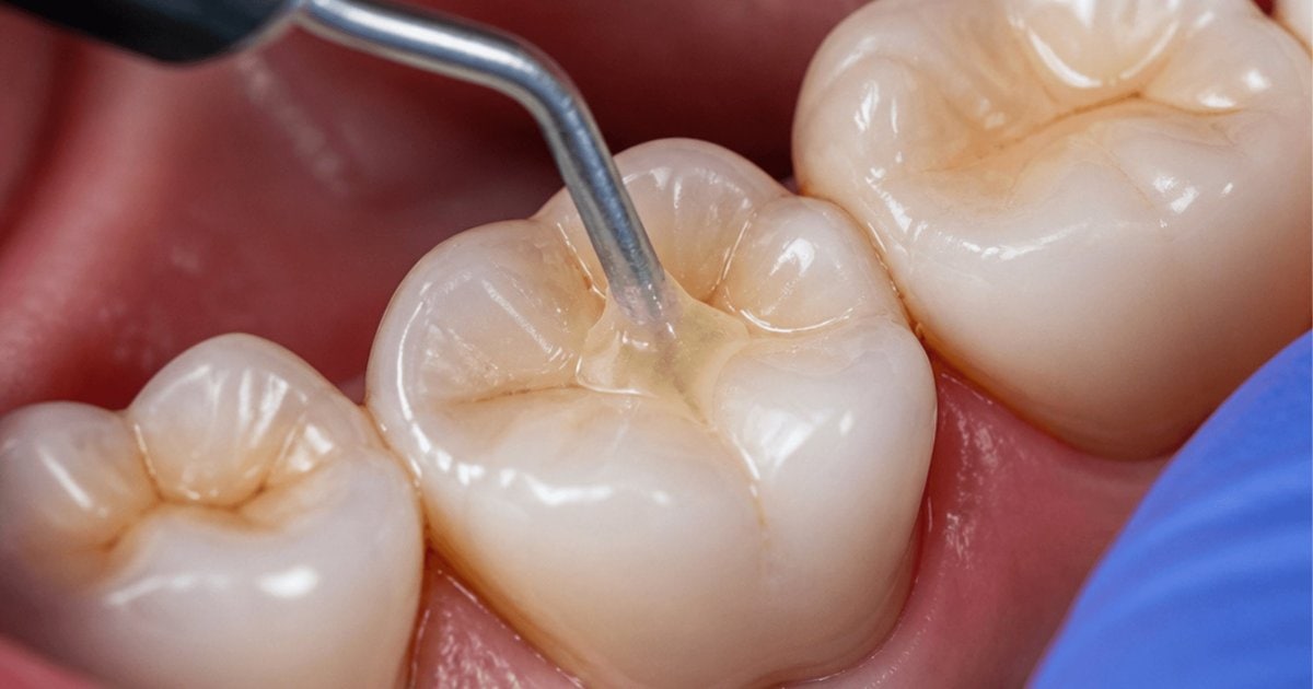 Dentist placing a tooth-coloured dental filling in Cheltenham