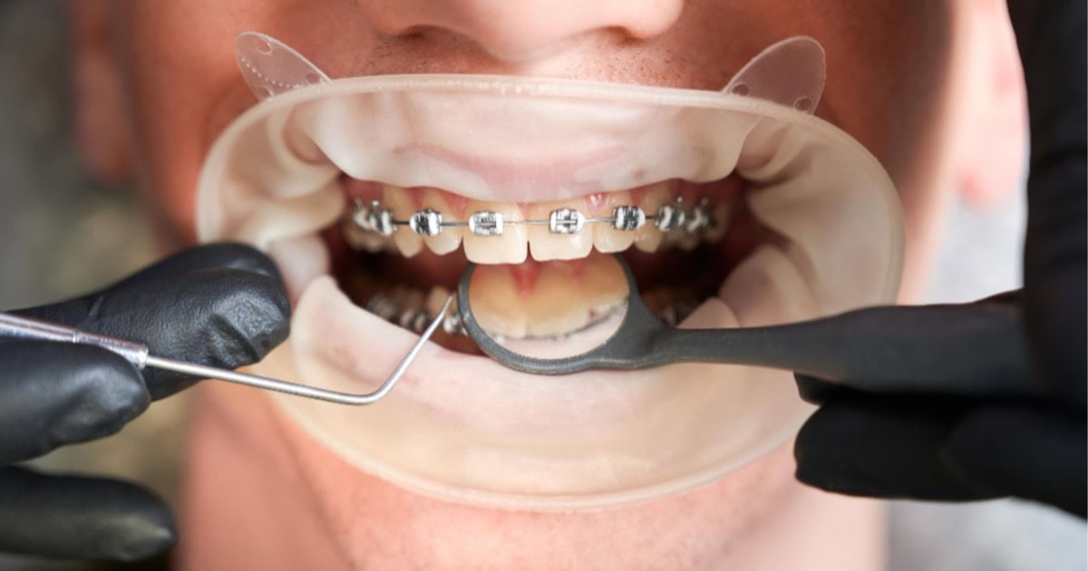 closeup of teeth with orthodontic braces in Cheltenham