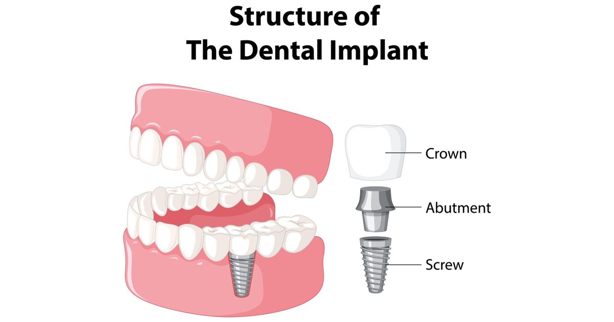 Diagram of a dental implant in Cheltenham