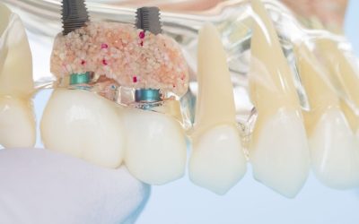 Dental Bone Graft: Why You Might Need One Before an Implant