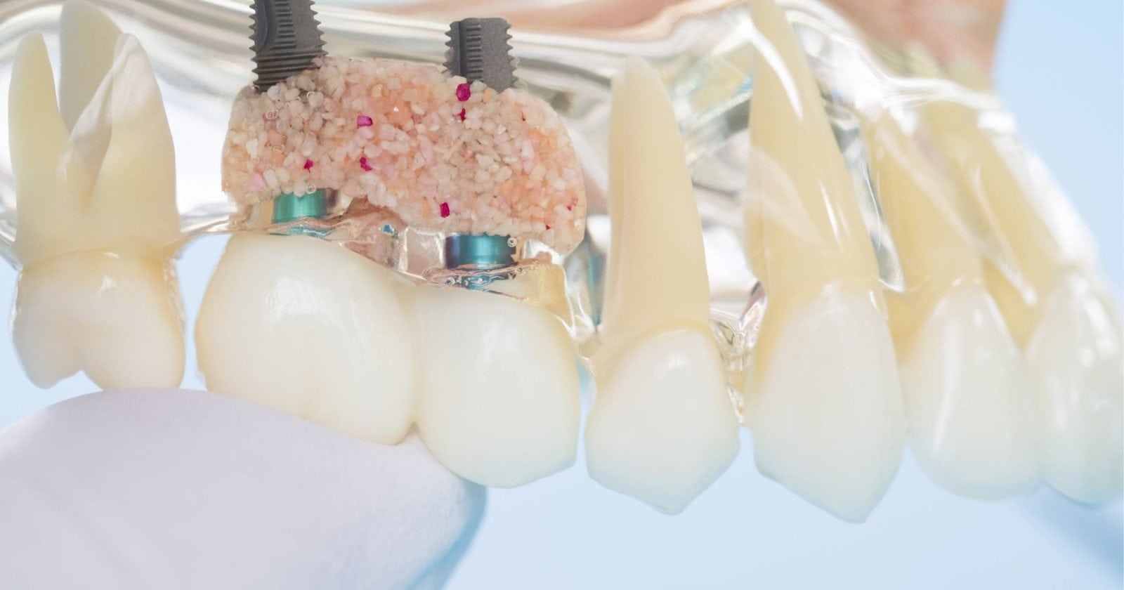 Teaching model of a jaw showing two dental implants surrounded by bone graft material in Cheltenham
