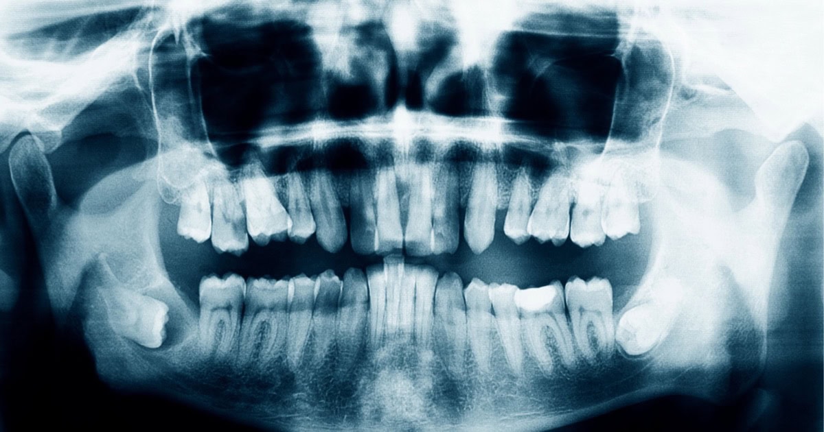 Dental X-ray showing wisdom teeth in Cheltenham